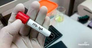 TTG- IgA (Tissue Transglutaminase IgA Antibody)