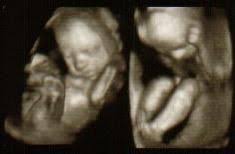 USG LEVEL II (Ultrasound Level II, Anomaly scan)