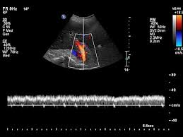 Ultrasound Doppler Abdominal