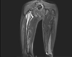 MRI Left Thigh