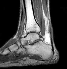 MRI Left Ankle