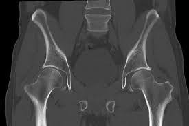 CECT HIP (CT Scan Hip with Contrast)