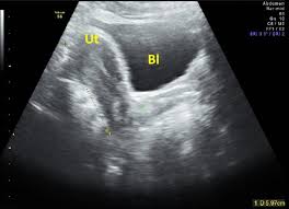 Ultrasound Lower Abdomen (USG L/A)