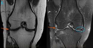 MRI Left Knee