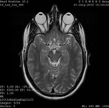 MRI Orbit