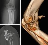 NCCT Left  Elbow (CT Scan Left Elbow)