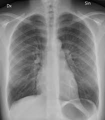 X Ray Chest - PA View