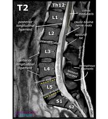 MRI Lumbar spine (L Spine)