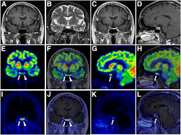 MRI Dynamic Contrast Study Pituitary