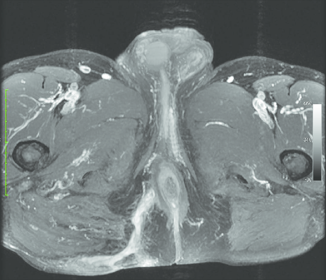 MRI Fistulogram / Sinogram