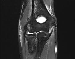 MRI Left Elbow