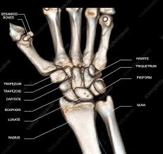 NCCT Right Wrist (CT Scan Right Wrist)