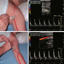 Ultrasound Doppler Peripheral Arterial (Both Upper Limbs )
