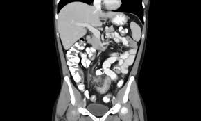 CT Scan upper Abdomen (NCCT Upper abdomen)