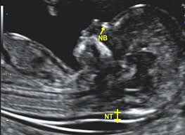 USG NTNB (Ultrasound NT and NB scan)