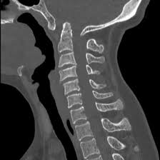 CT Scan CVJ (CT cranio-vertebral junction)