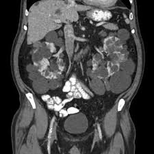 NCCT Whole Abdomen (W/A) (CT Scan Whole Abdomen)