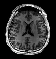 MRI Brain with DWI (Diffusion)