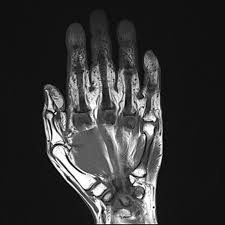 MRI Left Hand
