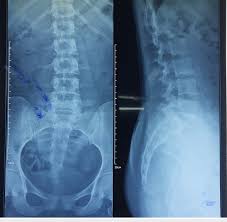 X Ray Lumbar spine - AP and Lateral View (AP & LAT View)