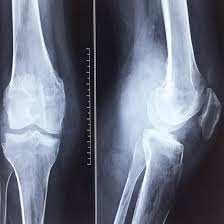 CECT Right Knee (CT Scan right knee with contrast)