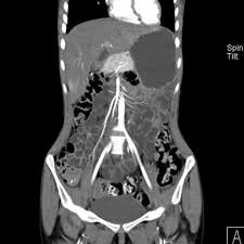 CT Enterography (CT Scan Enterography)