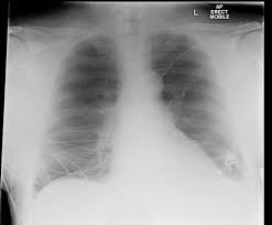 X Ray Chest - AP View