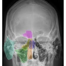 CECT Head (contrast)