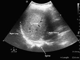 Ultrasound Upper Abdomen (USG U/A)