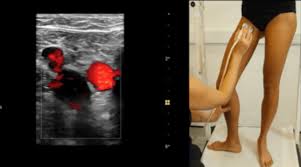 Ultrasound Doppler Peripheral Venous (Both Lower Limbs )