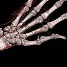 NCCT Left Hand (CT Scan Left Hand)