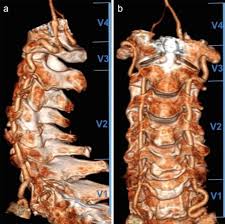 CECT CVJ (CT Scan cranio-vertebral junction with contrast)