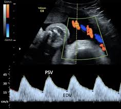 Ultrasound Doppler Obstetric (OBS)