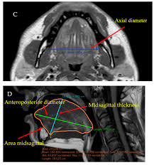 MRI Tongue