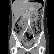 CT Abdomen Dual phase (Contrast)