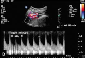 Ultrasound Doppler Peripheral Arterial (Both Lower Limbs )