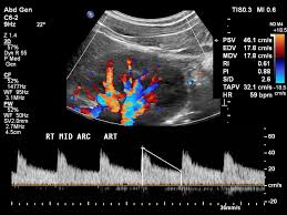 Ultrasound Doppler Renal