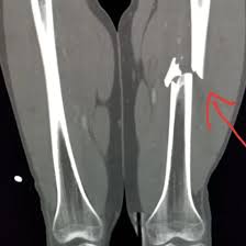 CECT Left Thigh (CT Scan left thigh with contrast)