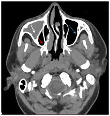 NCCT PNS Axial + cornual