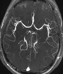 MR Angiography Brain