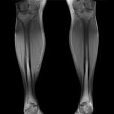 MRI Left Leg