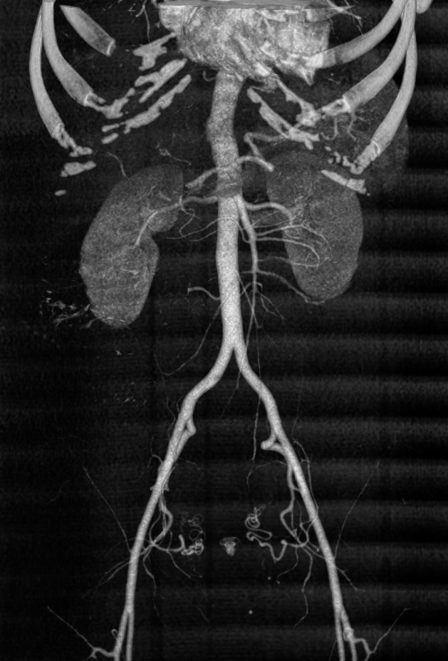 CT Renal Angiography