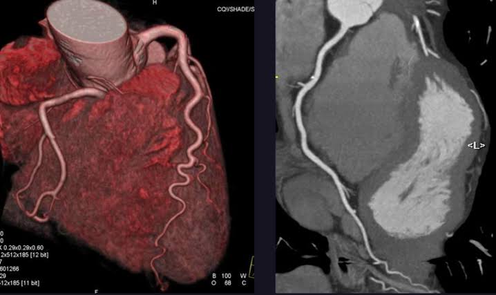 CT Coronary Angiography