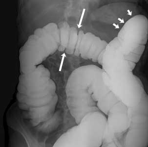 Barium Enema