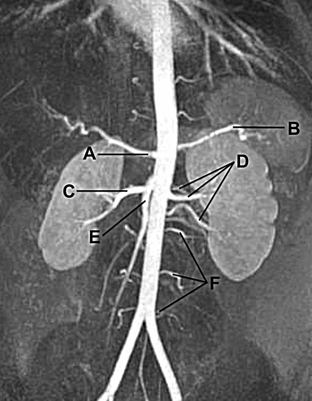 MRI Renal Angiography