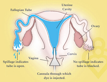 HSG (Hysterosalpingogram)