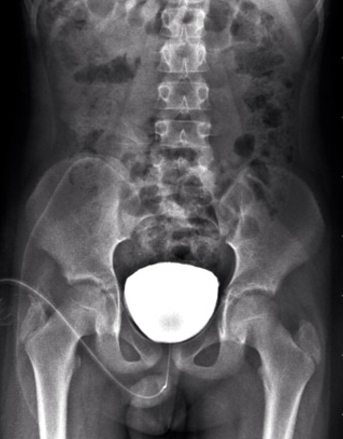 MCU (Micturating Cysto-Urethrogram)