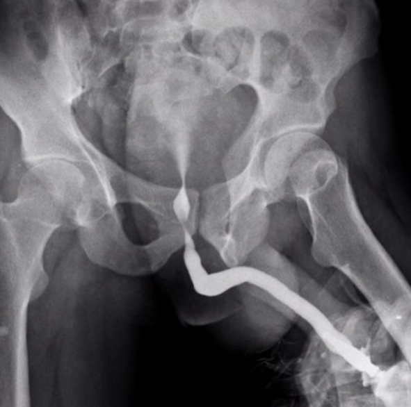 RGU (Retrograde Urethrogram) X-RAY