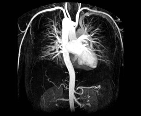 MRI Cardiac Angiography